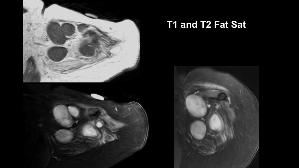 Figure 2 for case Stump neuromas